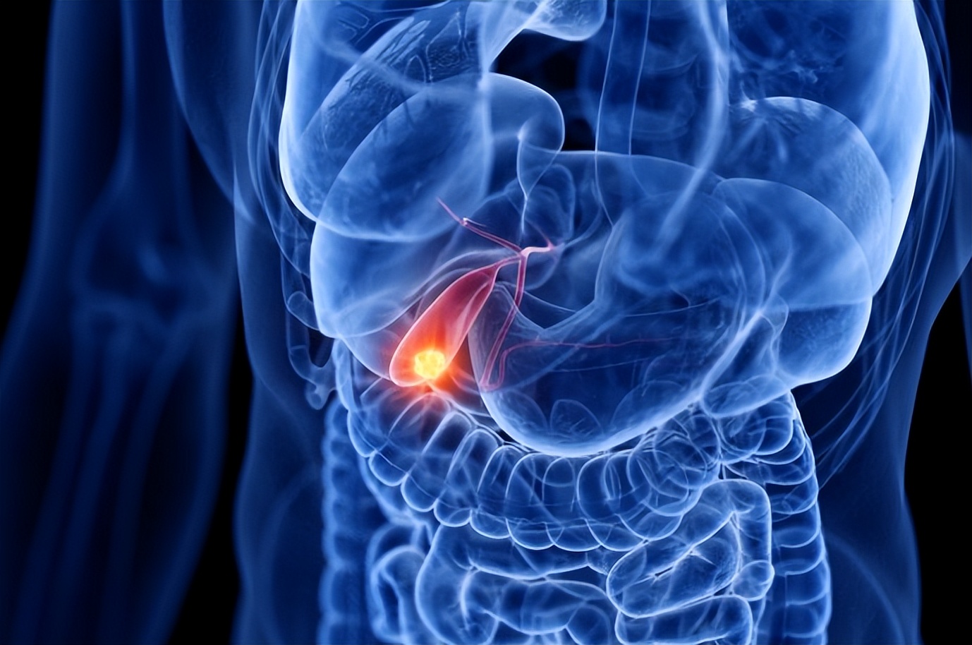 胆管细胞癌靶向药物药名,首款胆管癌fgfr靶向疗法获批