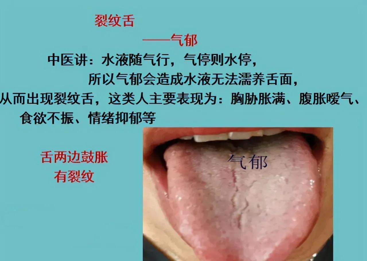 阴虚裂纹舌怎么调理,裂纹舌调理的经历