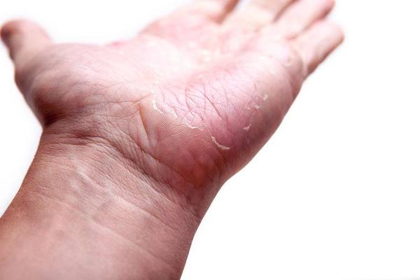 手脱皮反复发作,经常手脱皮是什么原因