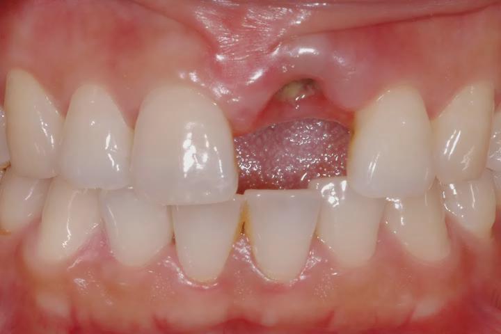 种牙前为什么要做牙冠,种牙前为什么要清理肉芽