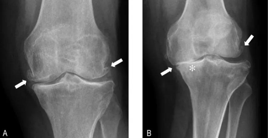 氨糖到底有没有效果,氨糖到底是噱头还是真的有用