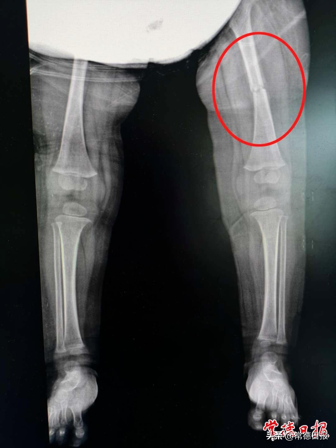 妈妈背着宝宝坐腰凳一起摔倒,爸爸抱娃不慎脚滑摔倒