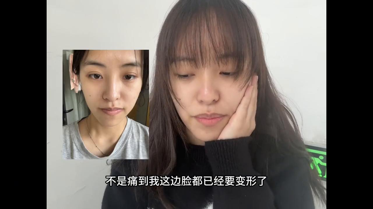 时隔两月终于给大家出这个牙齿视频了，好多人私信问我局部矫正