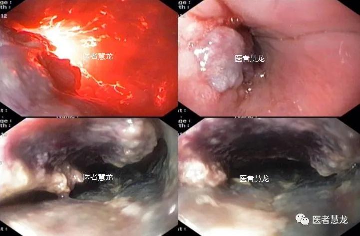 光动力疗法治愈进展期食管癌一例带来的思考和启示