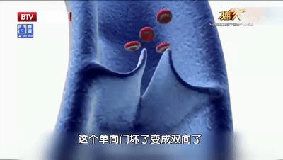 单腿小腿酸胀发麻是静脉曲张吗,腿酸胀难受怎么缓解静脉曲张