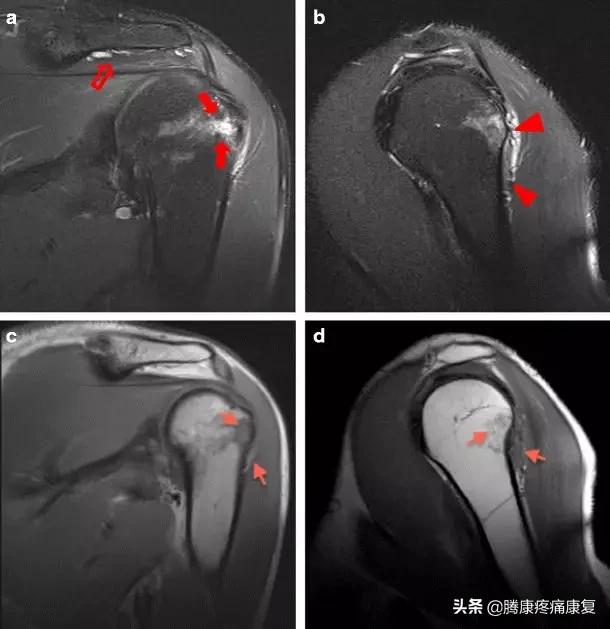 注射疫苗后的肩部疼痛