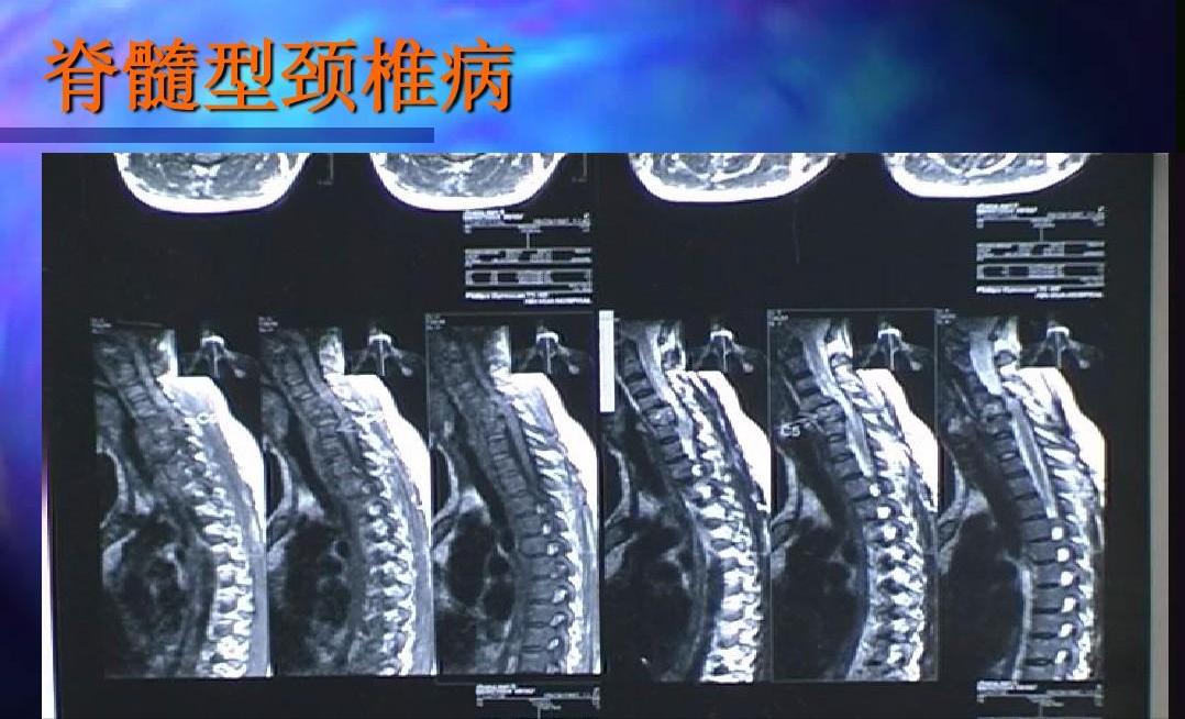 小孩玩游戏得颈椎病视频,孩子玩游戏导致身体瘫痪