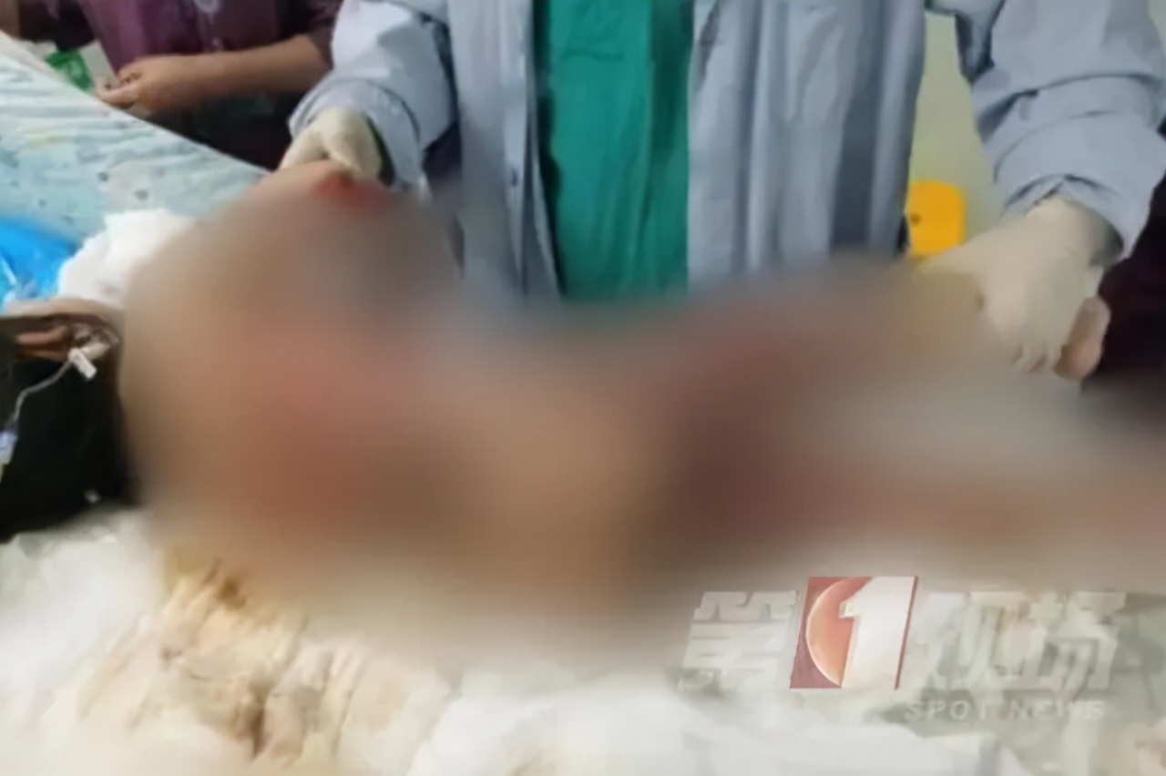 烫伤的紧急处理方法,烫伤紧急处理的第一步是