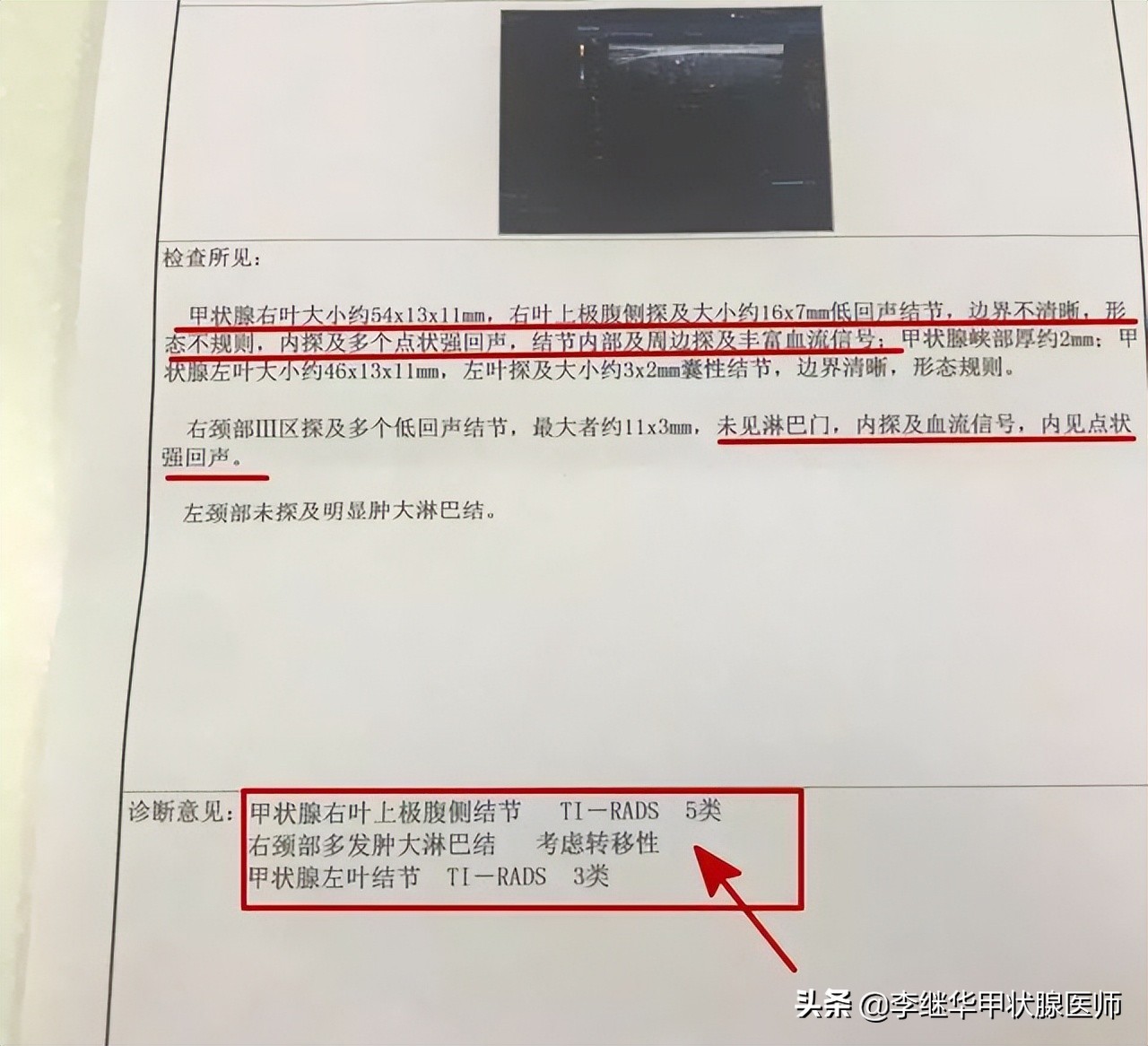 一旦发现有甲状腺结节就要手术吗,请问医生甲状腺结节是不是亚甲炎
