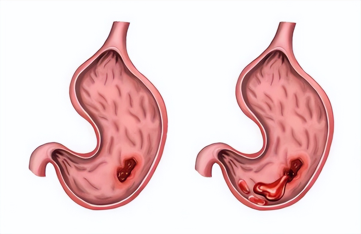 糜烂性胃炎？病根在肠道！仲景名方，清热养血，肠胃都安稳，收藏
