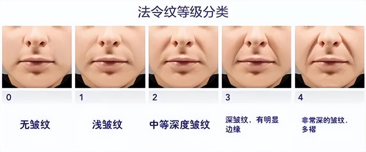 医美改善法令纹最快方法上海九院,上海九院祛法令纹效果