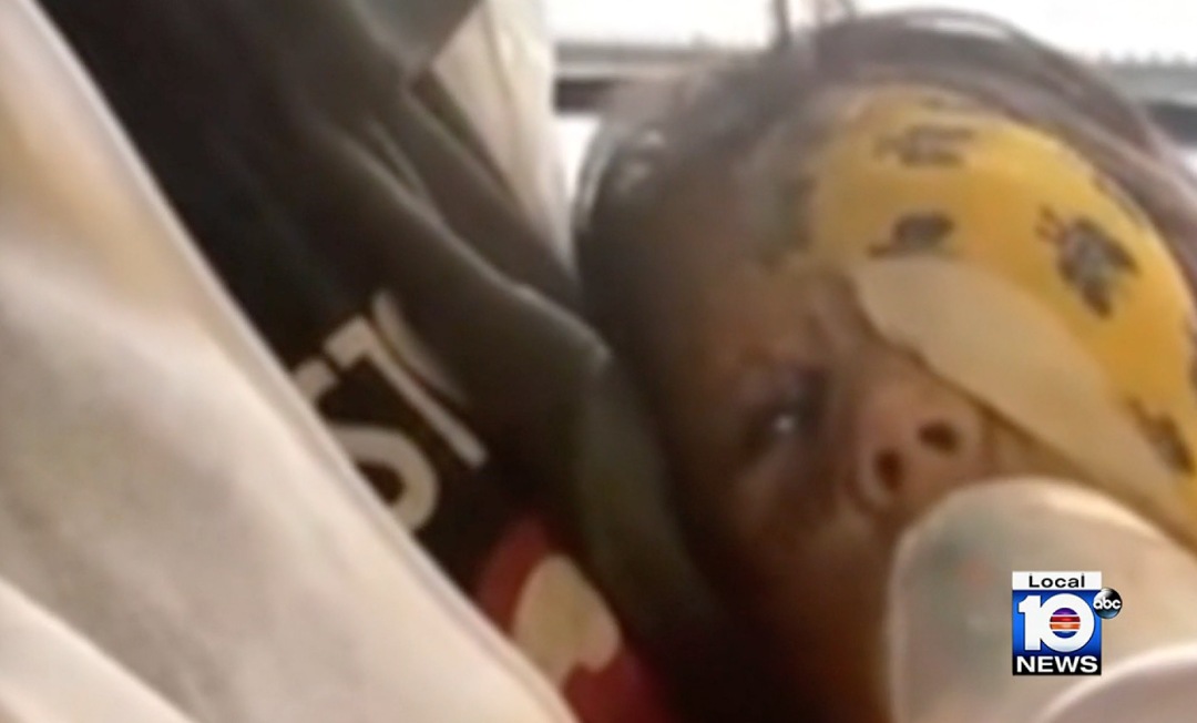 美国小女孩脸带“蝙蝠侠”黑印,治疗两年经过终于恢复肉色!