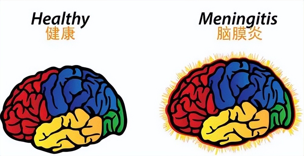小孩掏鼻孔导致脑膜炎,男童抠鼻子导致脑膜炎