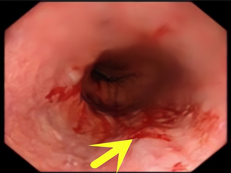 胃食管反流胸闷憋气打嗝怎么治,胸闷气短是胃胀还是食管反流