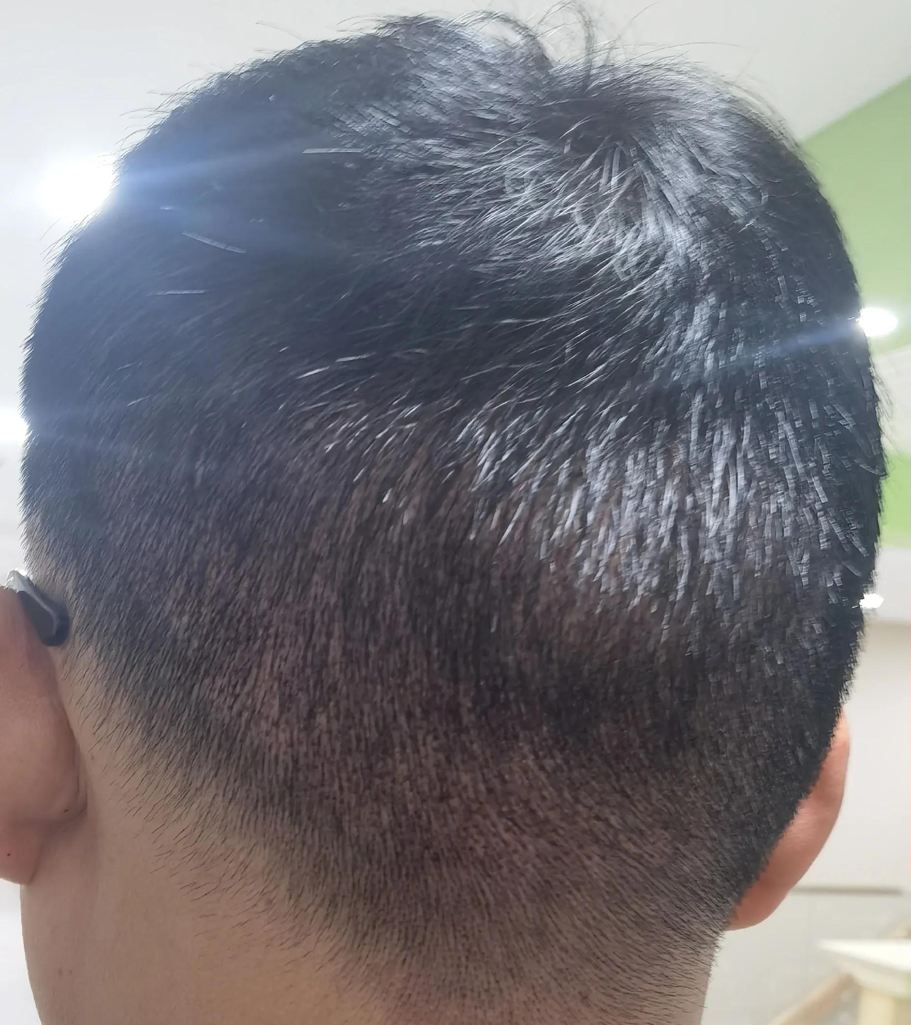 男士植发过来人真实感受,16000字讲述植发真实感受