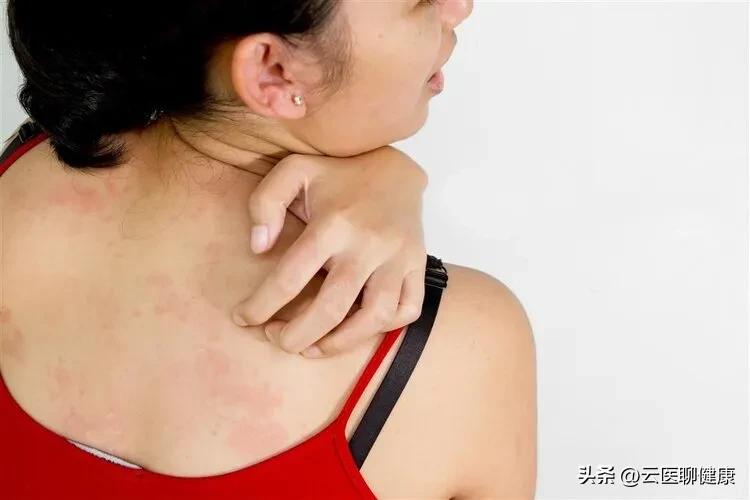 麻疹原因,麻疹由什么引起