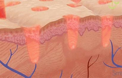 痘痘痘印痘坑改善全过程,学生祛痘痘和痘印痘坑简单的方法