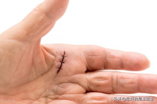 腱鞘炎中指咯吱响,腱鞘炎手腕疼痛咯嘣响