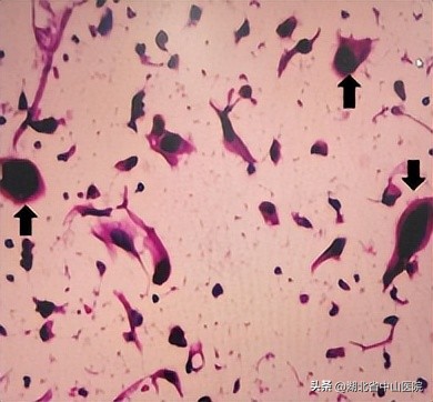 宫颈癌筛查tct异常hpv正常没事吧,确诊宫颈癌的tct结果是什么