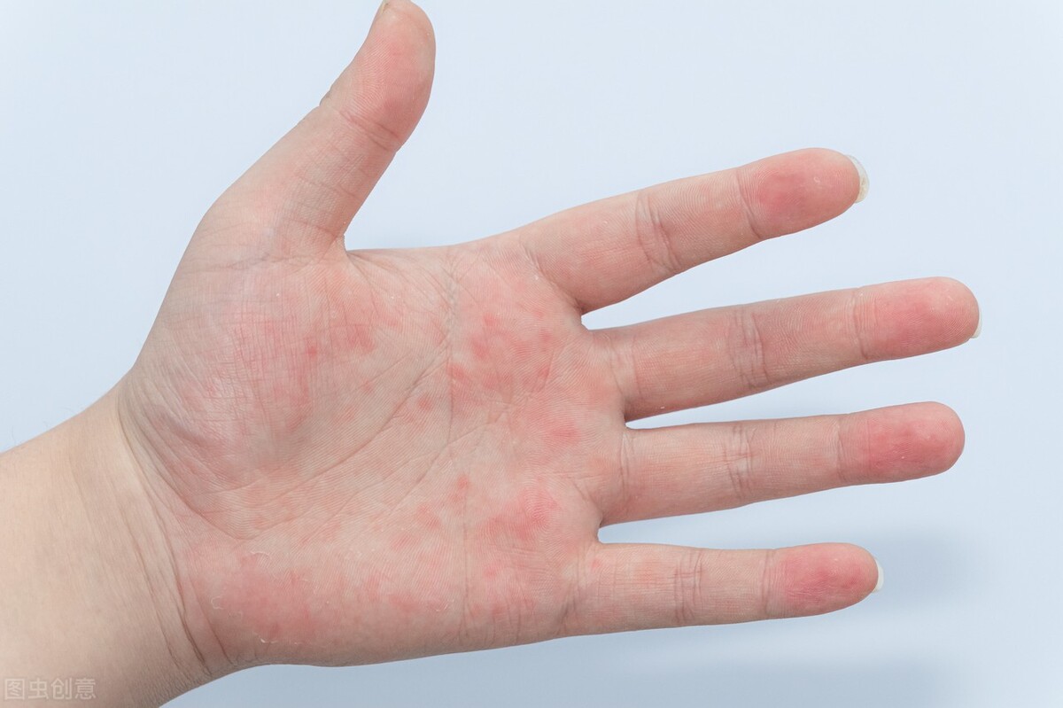 汗疱疹怎么预防和根治,汗疱疹如何根治和预防