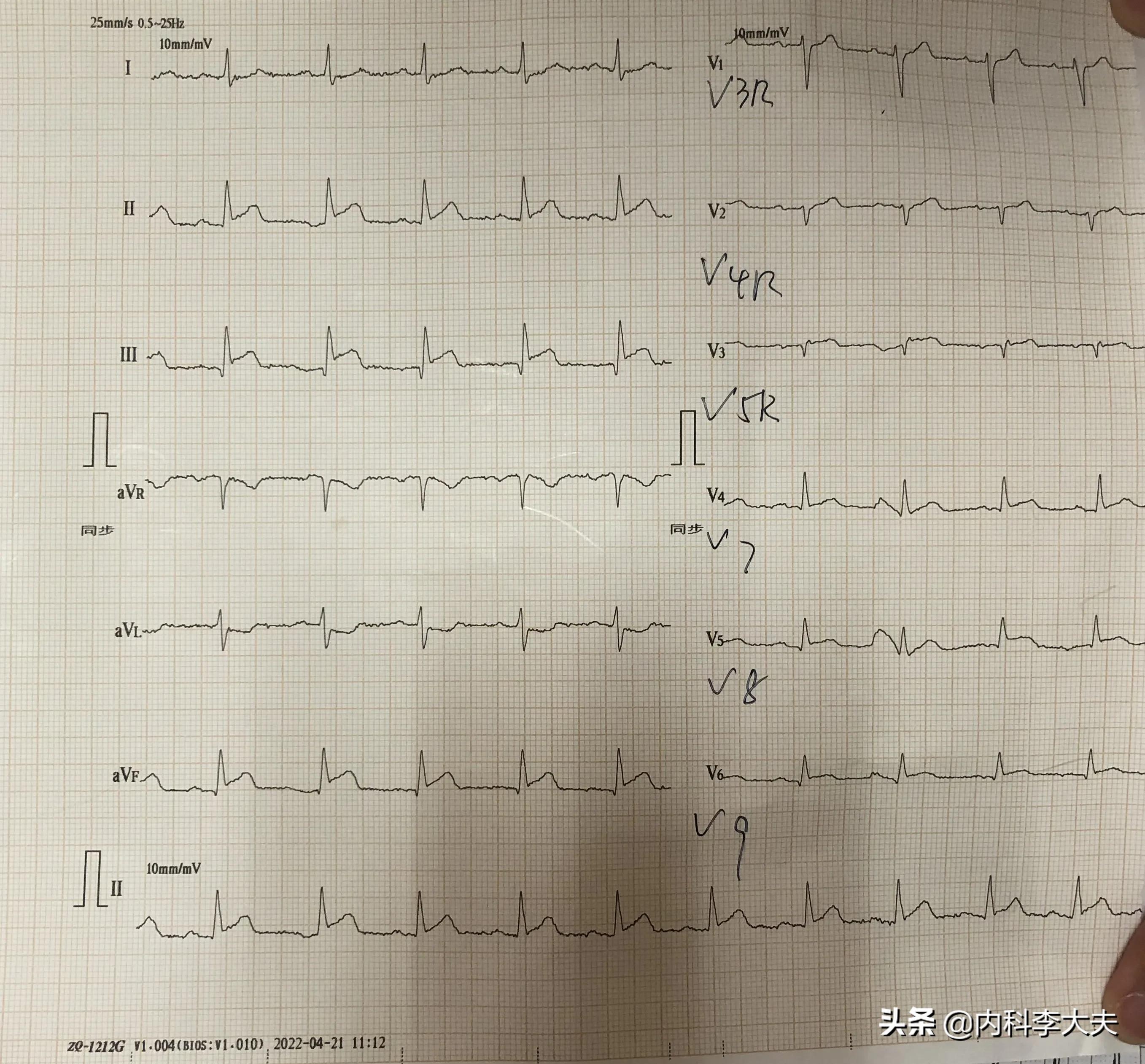 年纪轻轻有什么可怕的,年纪轻轻得了多发腔梗怎么办
