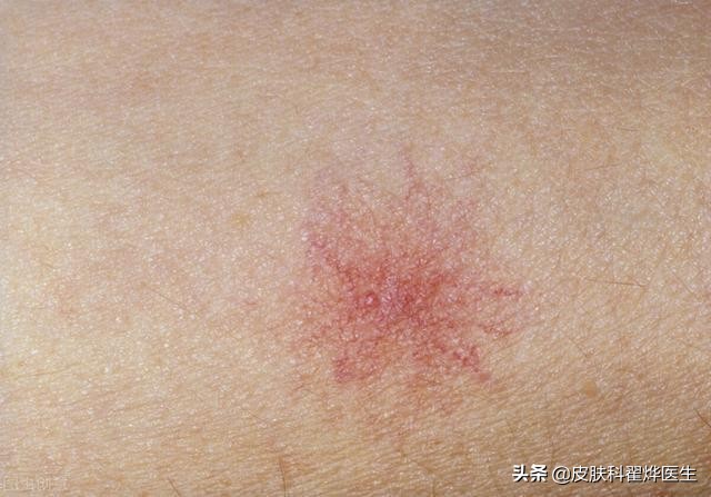 中老年人身上长红痣怎么回事,身上长了好几颗红痣一样的小点