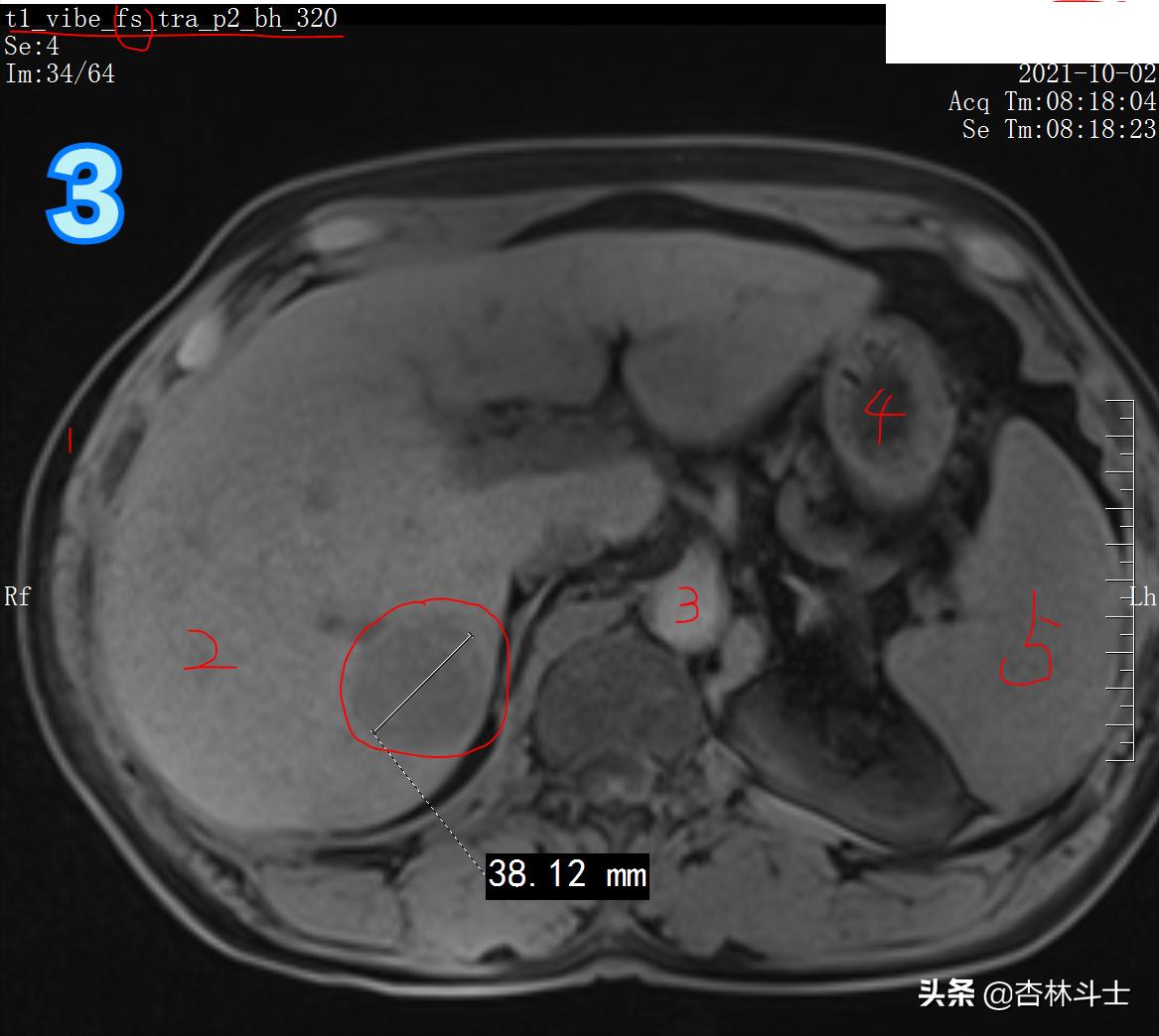 肝癌8公分肿瘤能活多久,肝癌细胞最大长多大