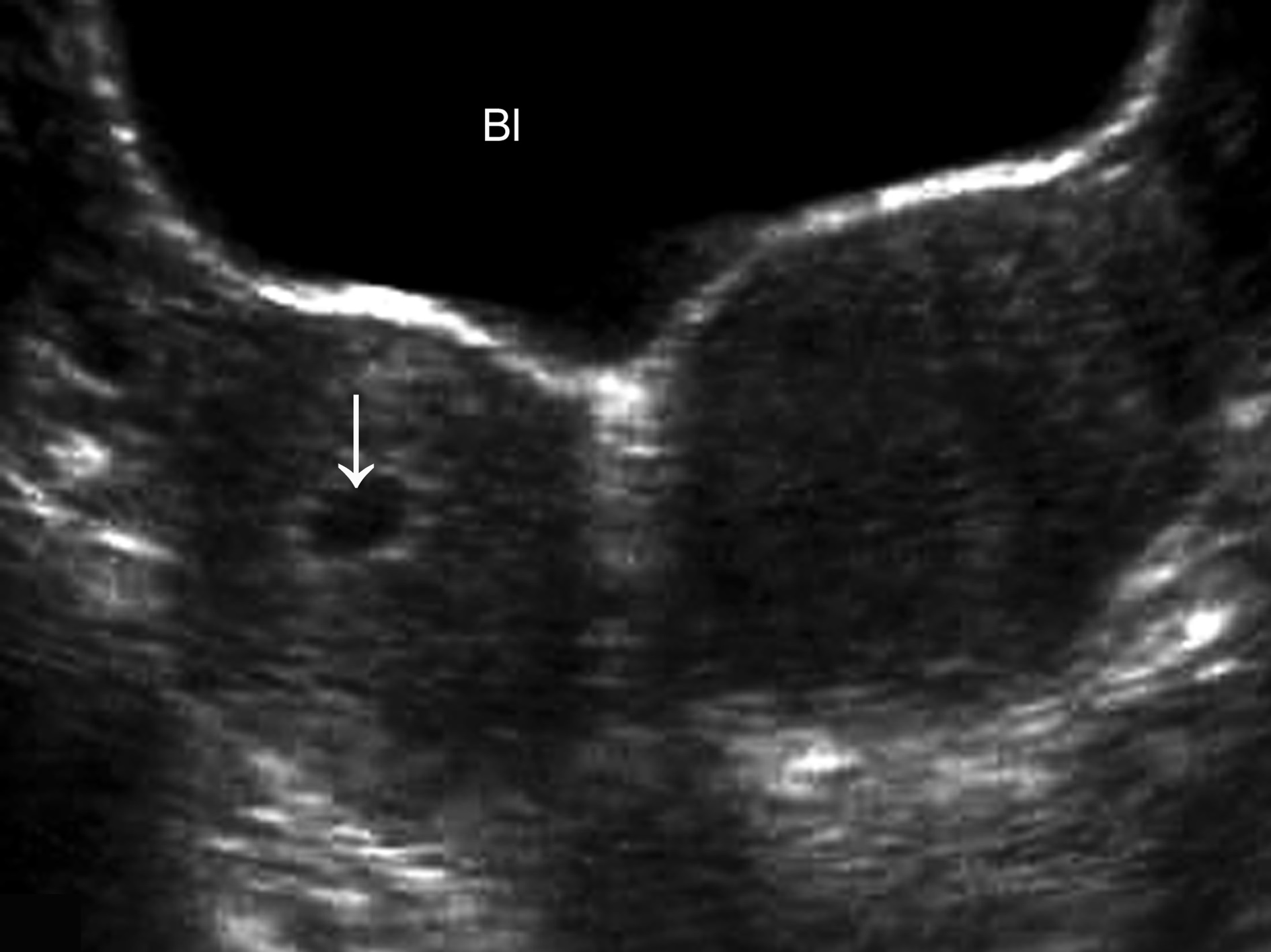 明明白白做超声33-13：双子宫妊娠