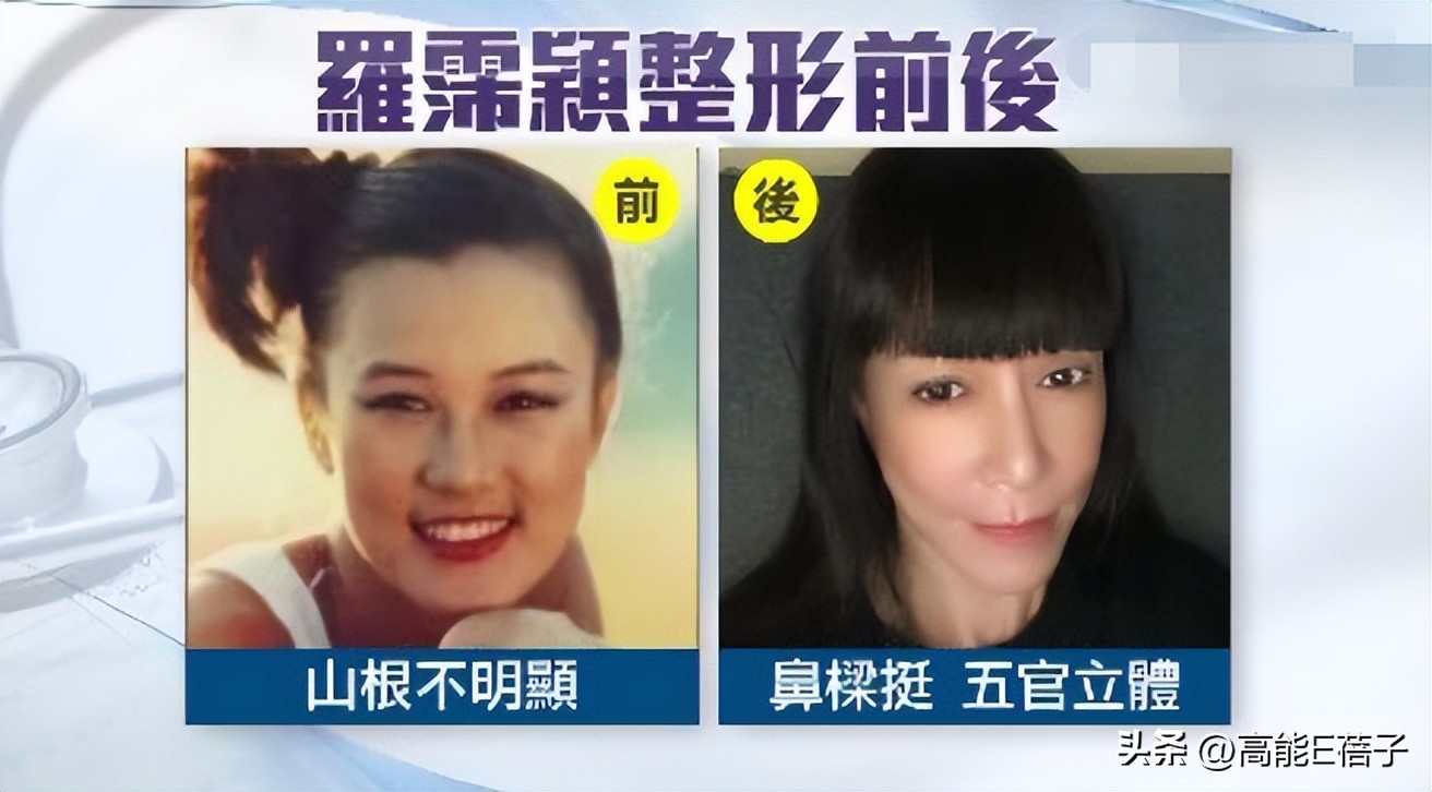 台湾艺人整形记：削骨换脸小场面，嫁给医师保修终身