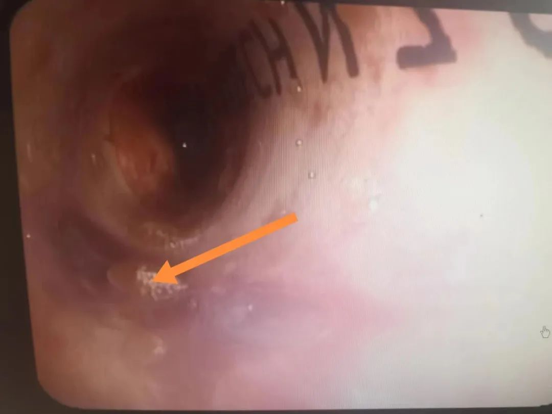 气管食道小瘘口能痊愈吗,食道管瘘还可以治疗吗