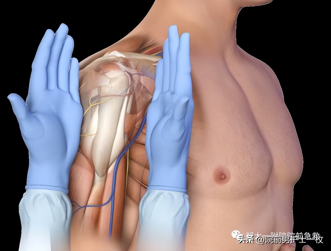 骨髓腔穿刺自动技术操作流程,骨髓腔穿刺急救