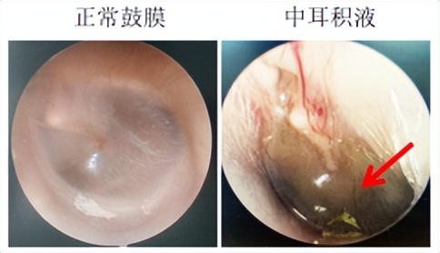 儿童分泌性中耳炎耳闷怎么缓解,分泌性中耳炎耳闷吃药11天没好转