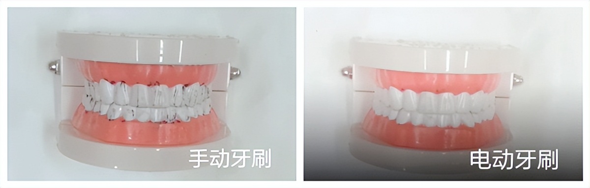 小孩用电动牙刷的好处与坏处,电动牙刷的好处与坏处