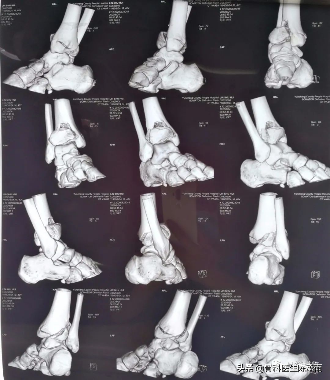 鑴氳笣楠ㄦ姌澶栧浐瀹氭敮鏋跺悗鎬庝箞鎭㈠,鑴氳笣楠ㄦ姌鐭宠啅鍜屽浐瀹氭敮鍏峰摢涓ソ
