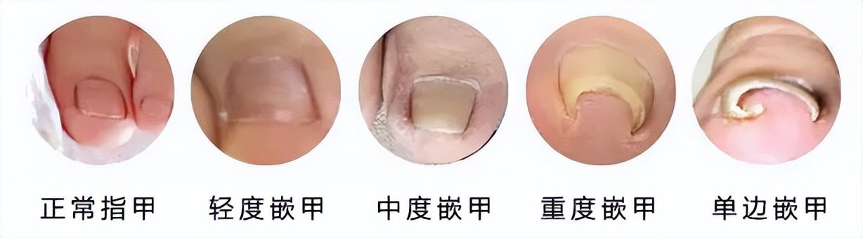 一走路脚趾甲痛,甲沟炎拔完脚趾甲很疼怎么办