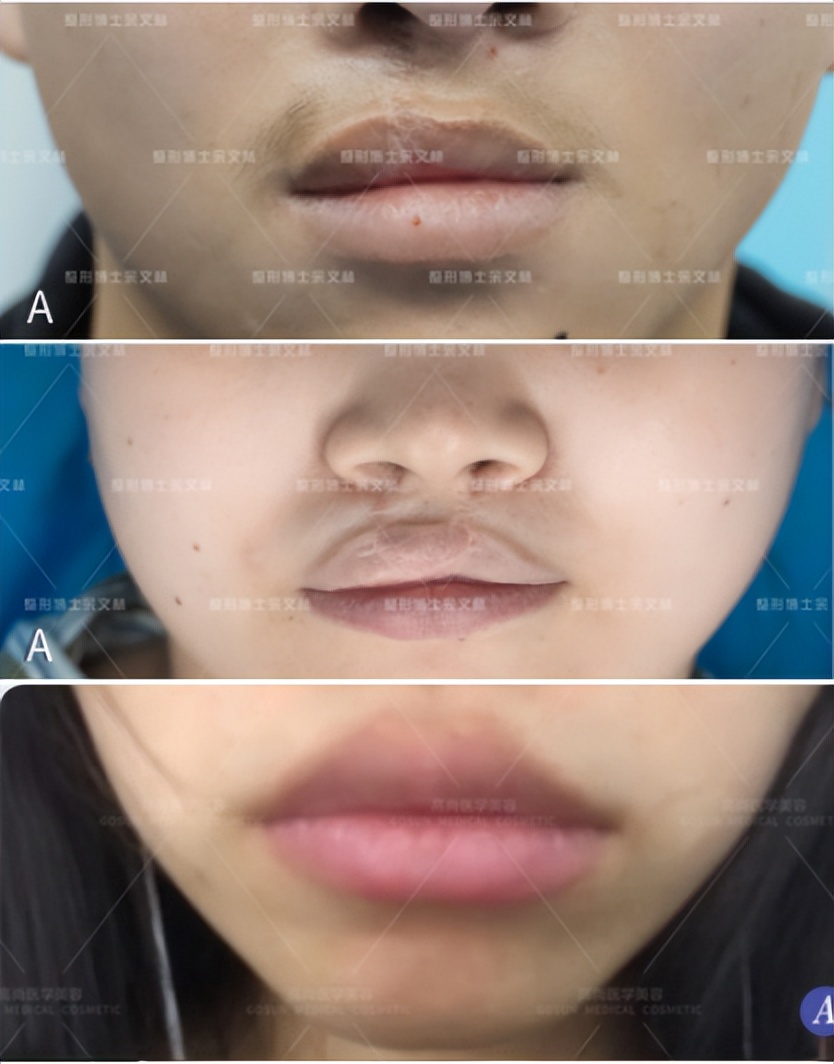 嘴唇厚其实有很多烦恼,嘴唇厚的女生有什么特点