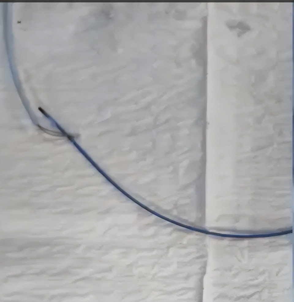 picc拔管遇导管断裂如何处理,picc导管断裂的影像表现