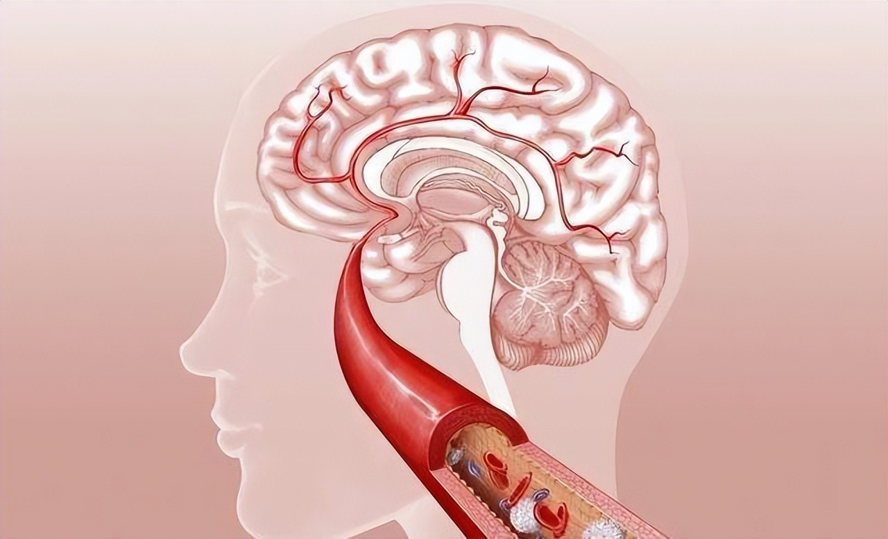 吃什么容易诱发心梗和脑梗,吃什么能预防心梗脑梗