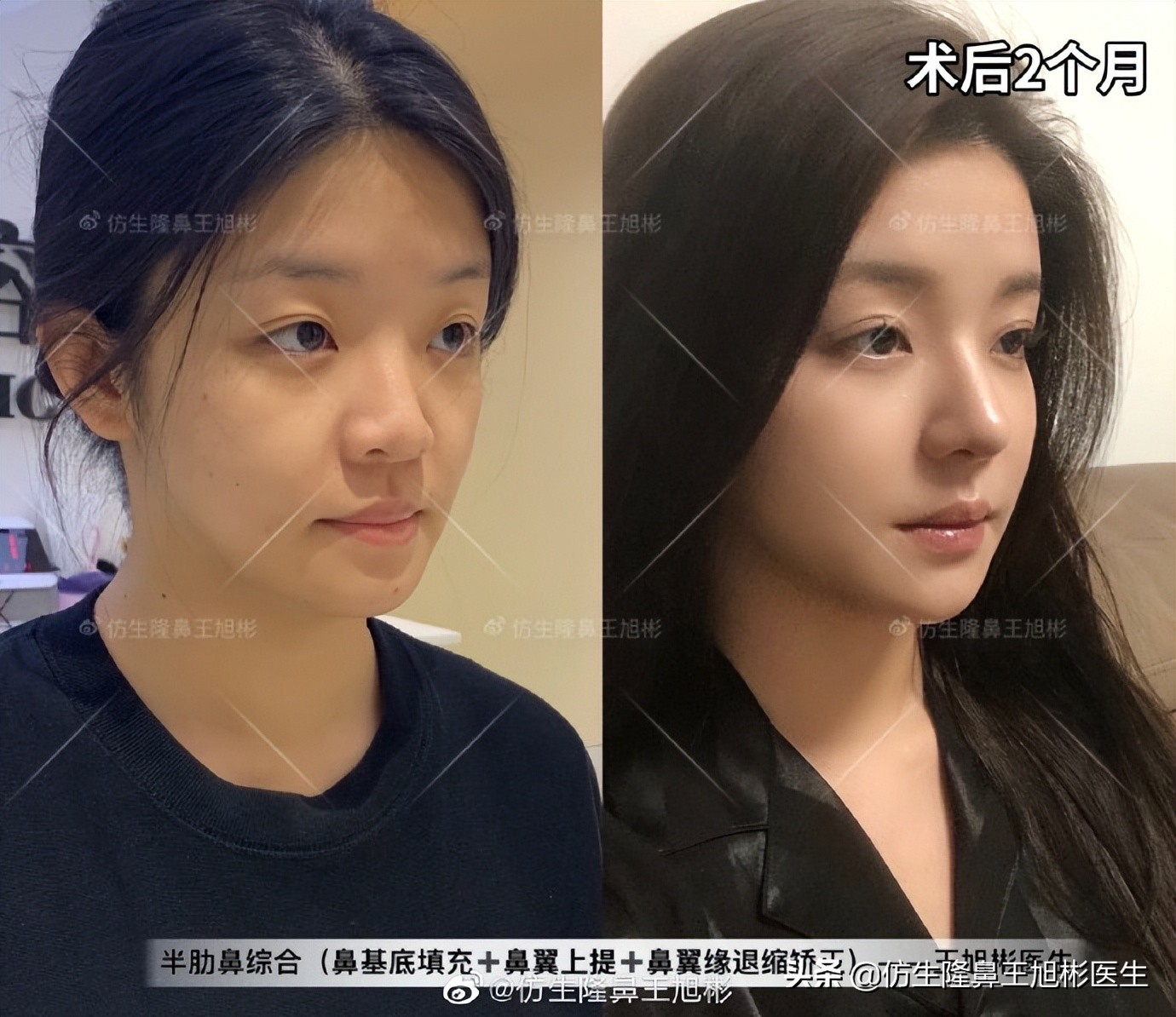 做一次鼻头缩小要多少钱好,可以只做鼻头缩鼻翼吗