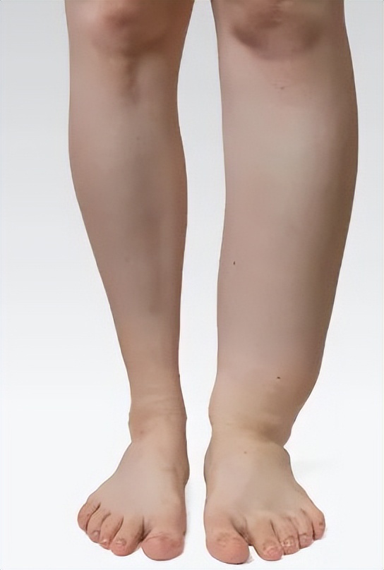 发现|继发性淋巴水肿的潜在治疗靶点及药物