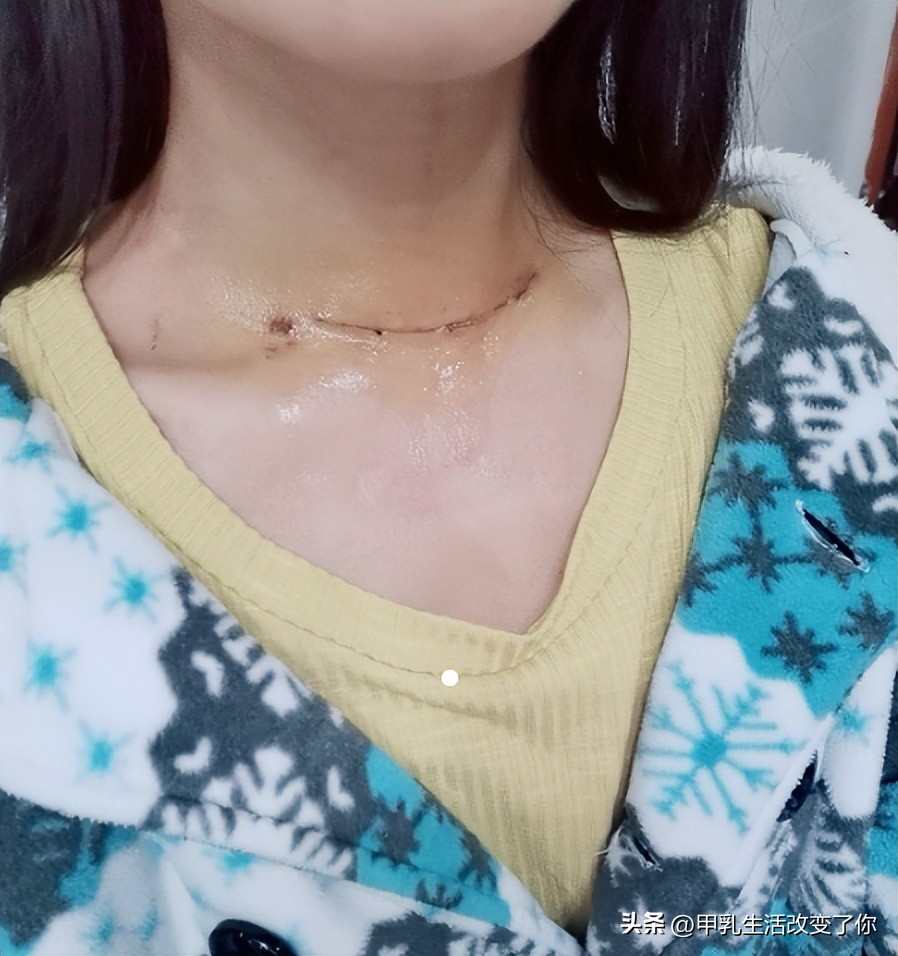 甲状腺结节微波消融最好的医院,临沂医院有甲状腺结节微波消融