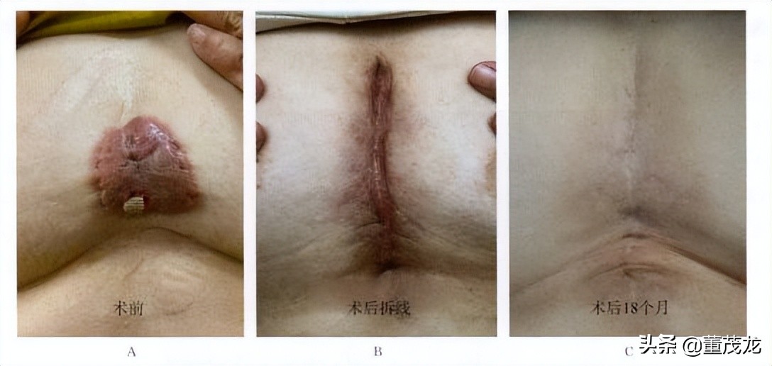 董茂龙说医:瘢痕的放射治疗