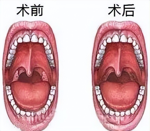 扁桃体发炎挂呼吸科,扁桃体老是发炎中医怎么调理