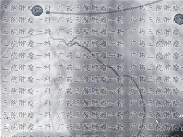 骨髓瘤误诊的可能性有多大,骨髓瘤能治愈吧