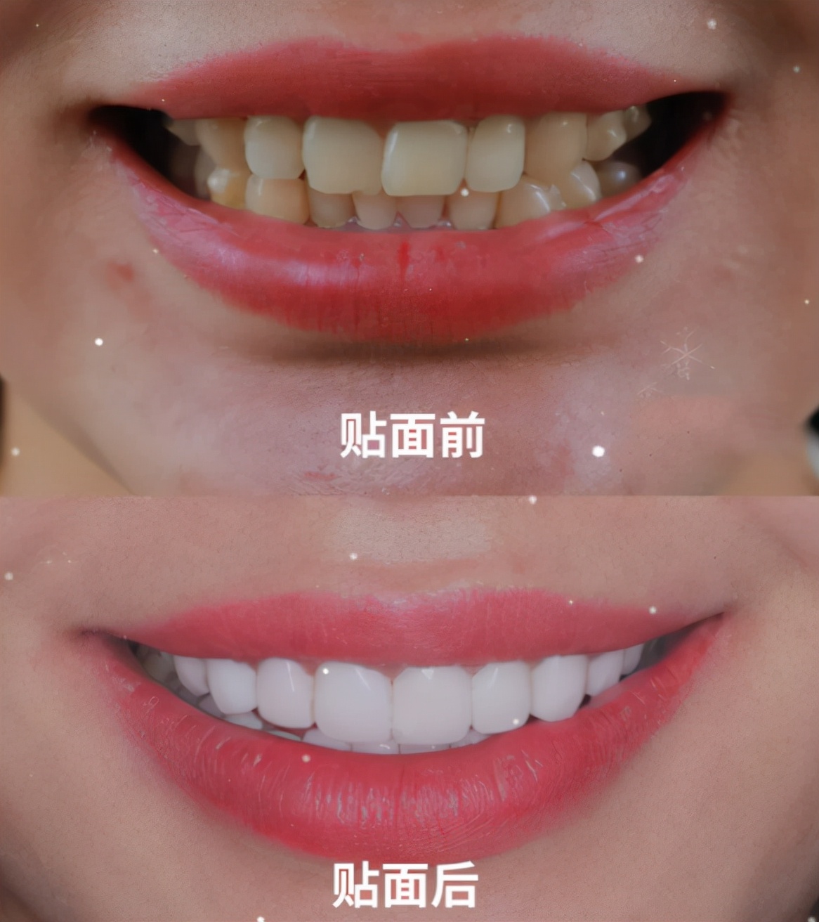 戴烤瓷牙的好处和坏处,烤瓷牙有几种它们的优缺点