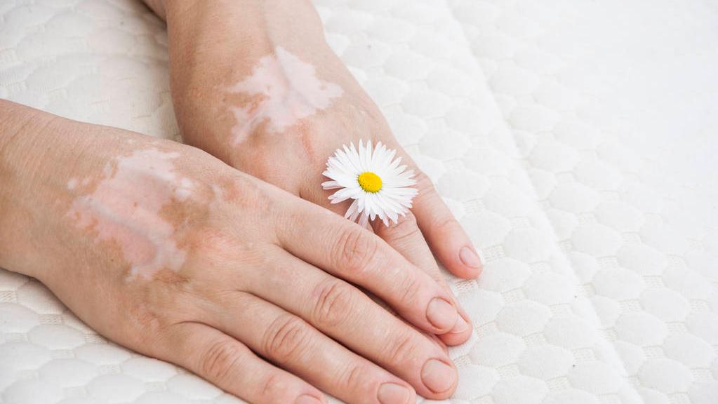 身上好多小片白癜风是什么白癜风,身上长了五处白癜风白斑严重吗