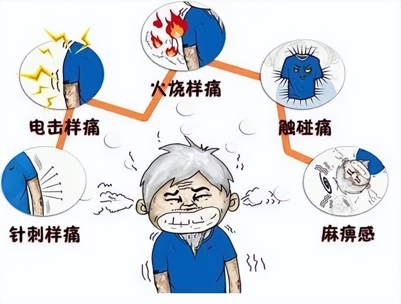 蛇缠腰带状疱疹为什么腰很痛,蛇缠腰带状疱疹要注意饮食吗