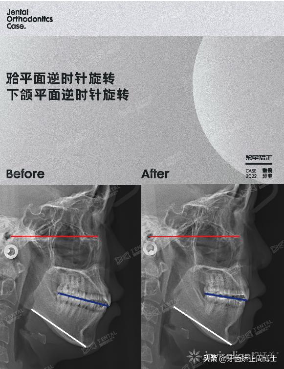 隐形矫正龅牙效果图,严重龅牙可以用隐形矫正吗