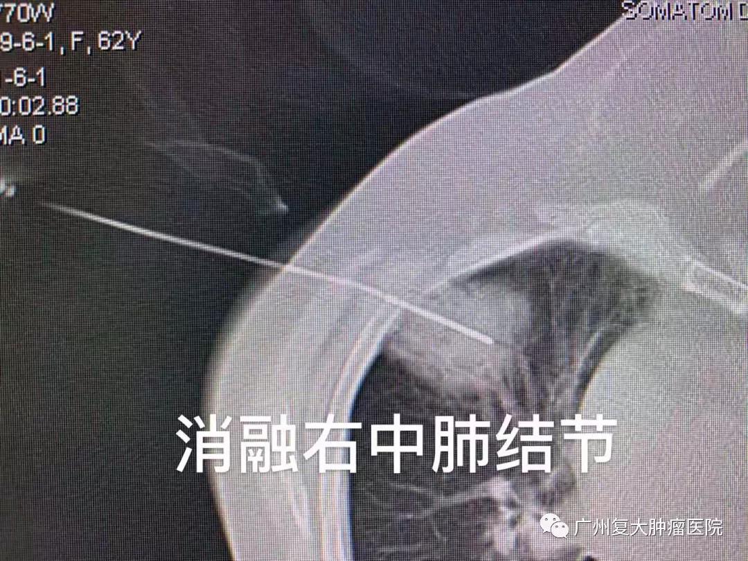 肺结节该观察还是手术？或许微创消融治疗是个不错的选择