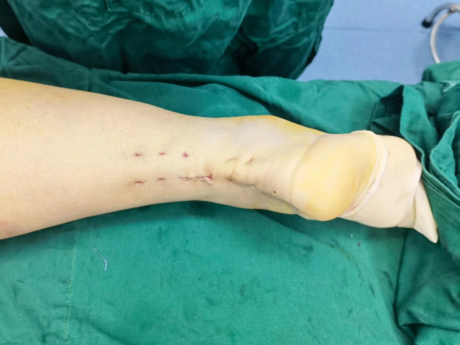 跟腱断裂术后疤痕增生怎么办,跟腱断裂术后跟腱如何愈合